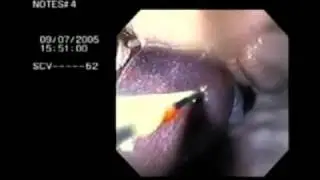 Natural Orifice Transvisceral Endoscopic Surgery