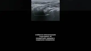 #узи #плечевоесплетение #изранов
