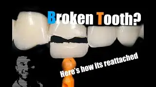 Broken Tooth Reattachment Using Veneer Cement and Air Particle Abrasion