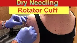 Dry Needling Rotator Cuff