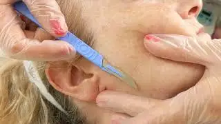 Dermaplaning Treatment