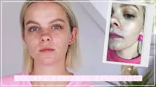 HOW I CURED PERIORAL DERMATITIS NATURALLY