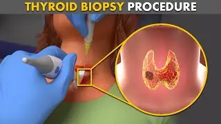 How Thyroid Biopsy procedure is performed?