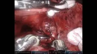 Completely Pre-Operative Planned Robotic Right S3 Segmentectomy, Assisted by 3D Reconstruction