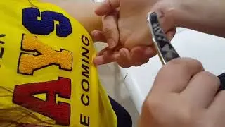 Carpal Tunnel syndrome and its treatment Technique.