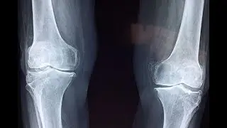 Artrosi 2: gli stili di vita che proteggono le articolazioni