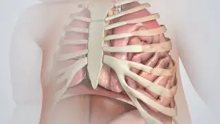 Reparación de hernia diafragmática congénita