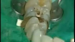 Restauración de Posteriores Dr. P.Colon - Quixfil /1