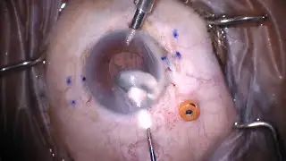 IOL Exchange of a dislocated IOL/Capsular Bag Complex and Recovery of Sommering Ring Fragment