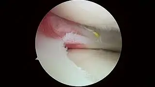 R knee chondroplasty and 6 22 23 VB