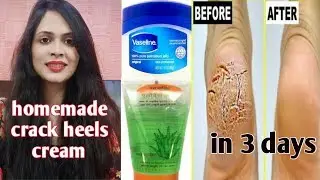 Crack heels home remedy cream | in 3 days reduce cracked heels completely