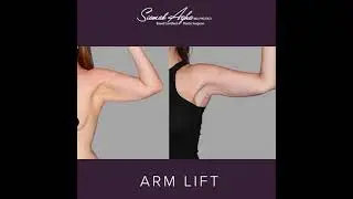 Arm Lift Before & After