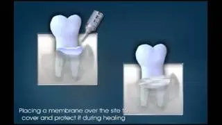 Tissue Regeneration - Miskin Ajax Dental
