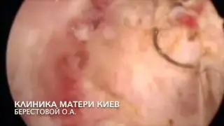 Резидуальный послеродовый эндометрит  Синдром Ашермана крайней степени