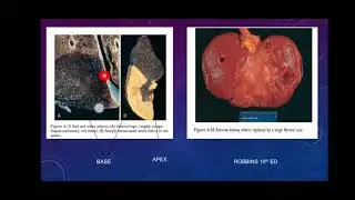 SPLENIC INFARCT- important gross and microscopy topic