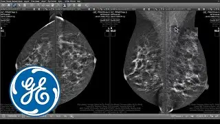 Centricity Universal Viewer Native Breast Imaging Demonstration | GE Healthcare