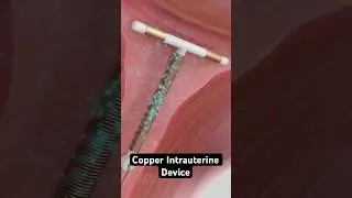 Copper IUD Birth Control (3D Animation)