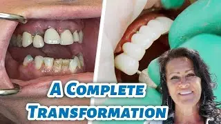 Another Stunning 3 on 6 Smile Transformation | Dr. Micah Weisenberg at Utah Smile Clinic