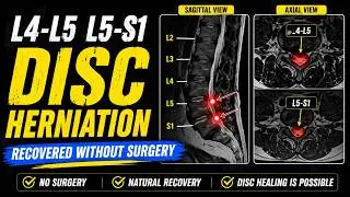 L4 L5   L5 S1 disc herniation recovery within 4 weeks
