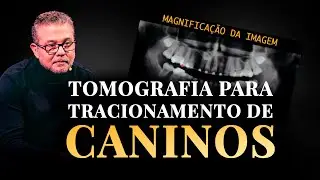 Tomografia para Tracionamento de Caninos 😏