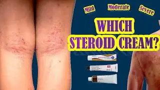 Which Steroid Cream Works Best For Eczema | Mild, Moderate, Severe Eczema Treatment