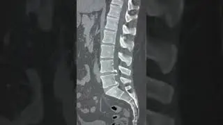 Annulus fibrosis calcification