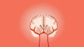 Hemorrhagic  Brain Animated Surgical video for medical interns Neuroologis