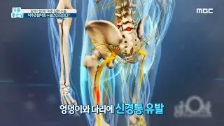 [HEALTHY] Changes on my spine! Spinal stenosis, surgery is the only answer?, 기분 좋은 날 210604