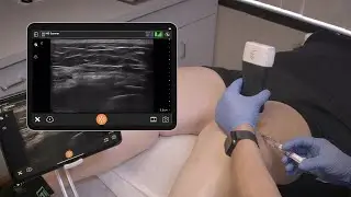 Suprapatellar Injection of the Knee - Ultrasound Scanning Technique