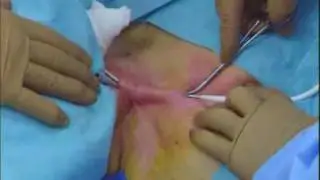 ProGuide™ Chronic Dialysis Catheter Insertion Procedure with Jeffrey Siegel, MD
