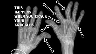 This Happens When You Crack Your Knuckles!