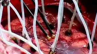 Right Frontal Craniotomy Performed With Image Guidance