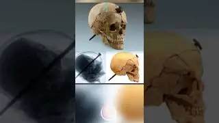 Tengkorak kepala dengan paku besi di dalamnya 😱 #history #shorts