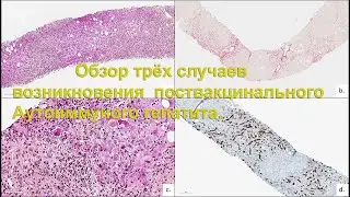 Обзор трёх случаев возникновения поствакцинального Аутоиммуного гепатита.
