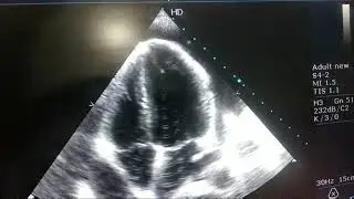 CARDIAC TAMPONADE ECHO APICAL FOUR CHAMBER VIEW