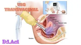 #34 USG TRANSVAGINAL