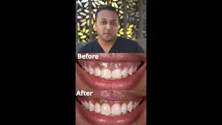 GET RID OF YOUR GUMMY SMILE! 2021 FIX