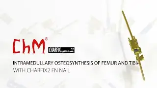 Intramedullary osteosynthesis of femur and tibia with CHARFIX2 FN Nail