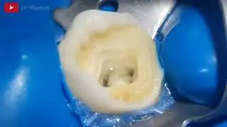 cómo se realiza una endodoncia