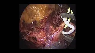 Pancreatectomia corpo-caudal + esplenectomia VLP - Tumor de Frantz