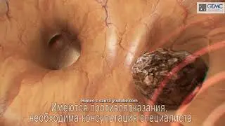 Плазмолифтинг в неврологии и ревматологии