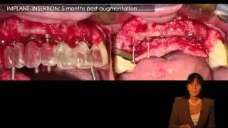 maxillary ridge augmentation