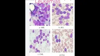 Understanding Leukemia  The Silent Invader AMT/ASCP Certification Exams