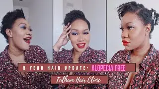5 Year Hair Update with Fulham Hair Clinic - Alopecia Free