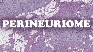 LE PERINEURIOME – PATHOLOGIE