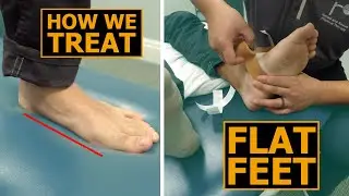 How We Treat Flat Feet | Collapsed Arches | Physical Therapy