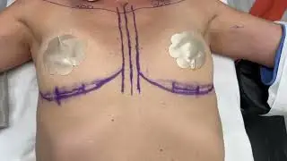 Going From a B to a C Cup with Implants! 