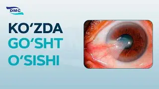 Ko'zda go'sht o'sishini davolash usullari   