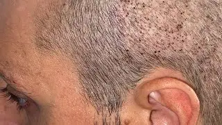 Реабилитация после ТРАНСПЛАНТАЦИИ ВОЛОС Как мыть голову до 12 дня 🫨😬