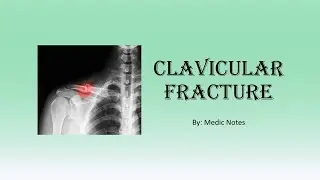 Clavicular fracture
